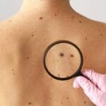 When To Get Checked For Skin Cancer Risk Factors And Key Signs
