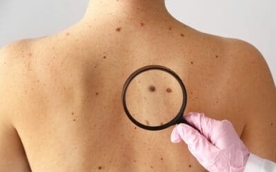 The Importance of Regular Skin Cancer Checks at The Skin Nurse